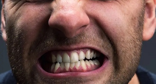 محافظ دندان قروچه برای افراد دارای بریس؛ اشتباهاتی که ممکن است به درمان شما آسیب بزند